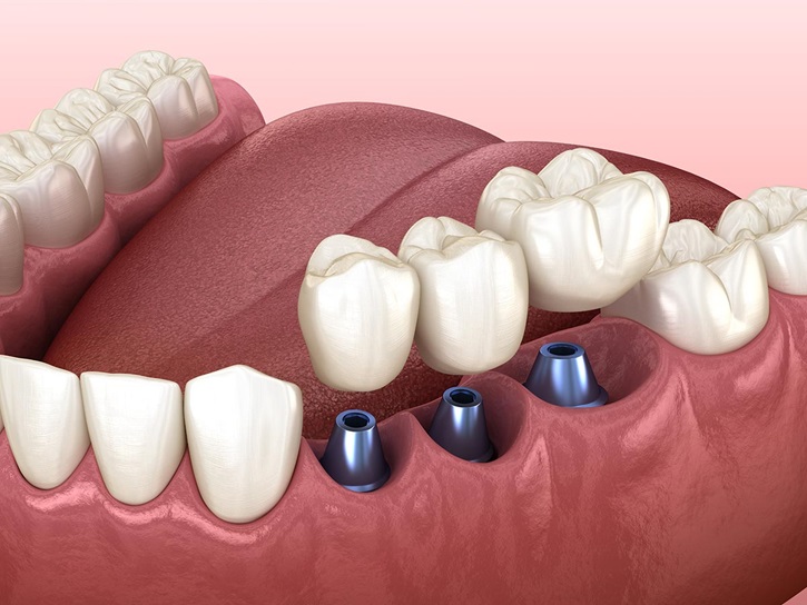 Are Dental Implants Real Teeth?