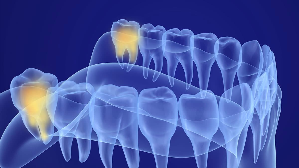 A Guide to Prepare for Wisdom Teeth Removal