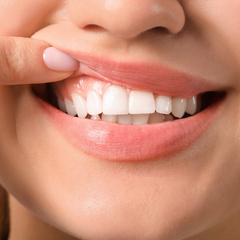 Understanding Plaque and Gingivitis: The Way to a Healthy Smile