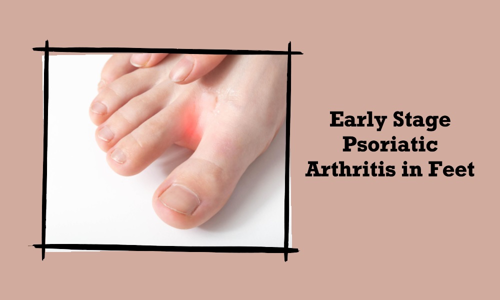 Early Stage Psoriatic Arthritis in Feet Pictures