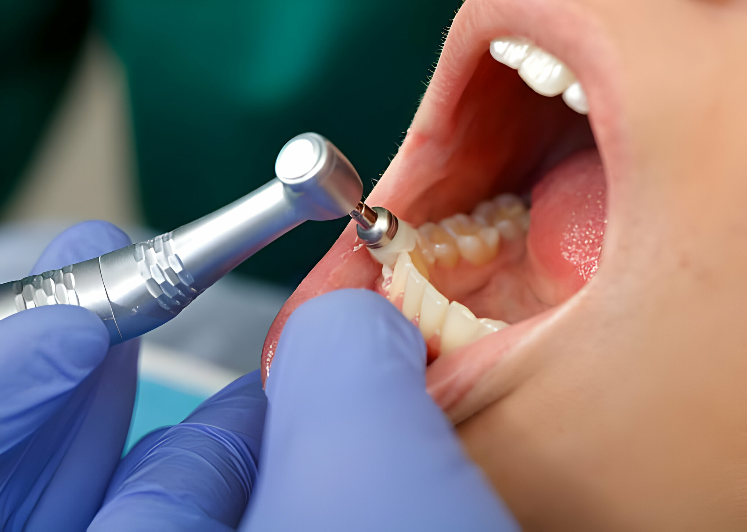 When Should You Consider Dental Cleaning in Fairhope?