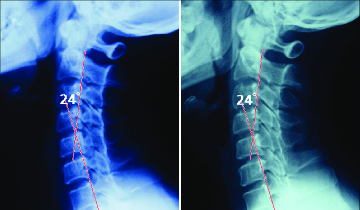 Restoring Balance vs. Straightening the Spine: Shifting Toward Functional Outcomes