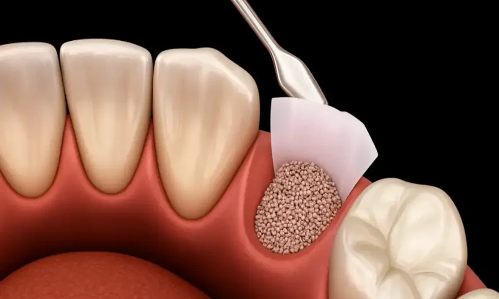 How Bone Grafting Prepares Patients For Dental Implants