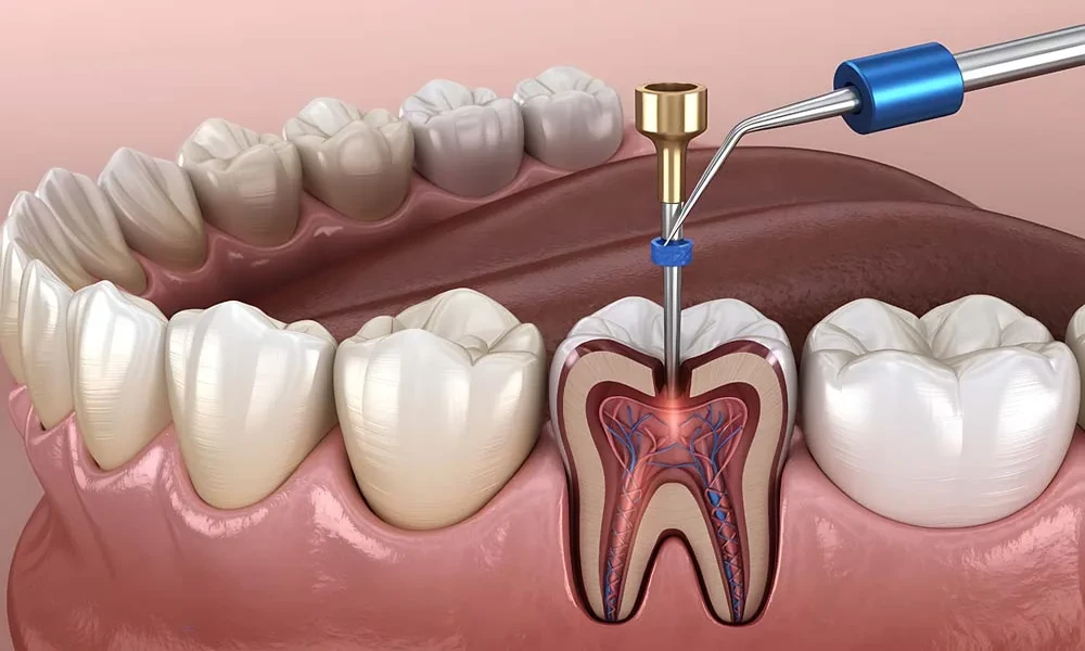 Why Antibiotics Do Not Replace Treatment For A Damaged Tooth
